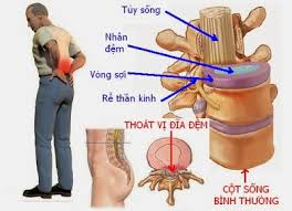 Nguyên nhân thoái hóa cột sống và thoát vị đĩa đệm