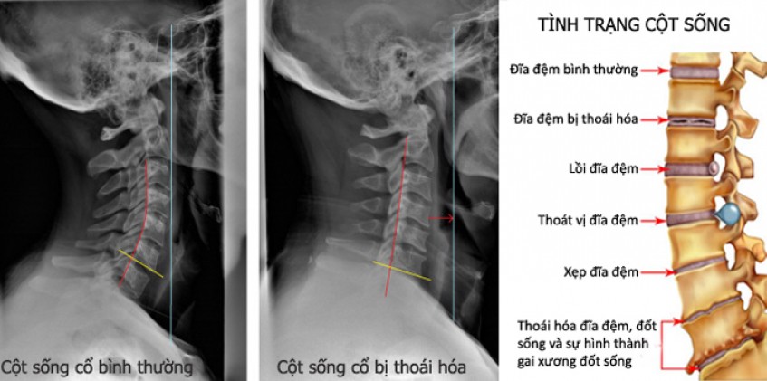 Nguyên nhân gây thoái hóa cột sống và thoát vị đĩa đệm