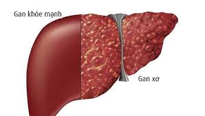 Điều trị Xơ Gan hiệu quả.