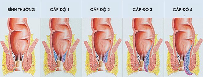 Triệu chứng và phân độ bệnh trĩ 