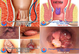 TRĨ HỖN HỢP