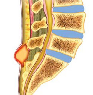 Viêm rò xoang lông là bệnh gì?